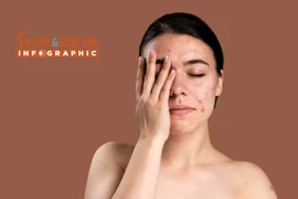 [INFOGRAPHIC] Những vấn đề về da thường gặp trong mùa hè