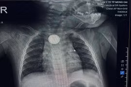 Bé 11 tháng tuổi bỏng loét thực quản vì nuốt pin cúc áo