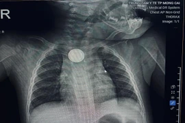 Bé 11 tháng tuổi bỏng loét thực quản vì nuốt pin cúc áo