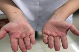 Điều trị hội chứng ống cổ tay bằng phương pháp cổ truyền