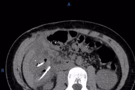 Bé gái 13 tuổi phải phẫu thuật cấp cứu vì nuốt nhiều xương gà
