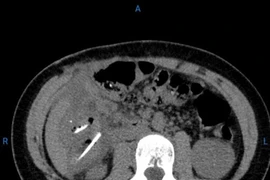 Bé gái 13 tuổi phải phẫu thuật cấp cứu vì nuốt nhiều xương gà