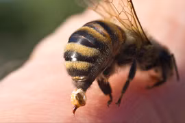 Cứu sống bệnh nhân bị ong vò vẽ đốt gây sốc phản vệ độ II 