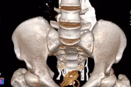 Nam thanh niên tự nhét ống cao su dài khoảng 1m vào bàng quang