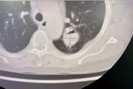 Người phụ nữ bị u nấm phổi phức tạp được phẫu thuật thành công