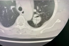 Người phụ nữ bị u nấm phổi phức tạp được phẫu thuật thành công