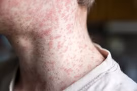 Mỹ ghi nhận số ca mắc sởi cao nhất trong vòng 33 năm qua