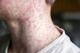 Mỹ ghi nhận số ca mắc sởi cao nhất trong vòng 33 năm qua