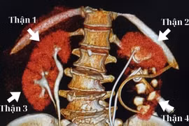 Người phụ nữ có tới 4 quả thận - dị tật bẩm sinh cực hiếm 