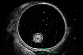 Không triệu chứng đi khám phát hiện u dưới niêm mạc