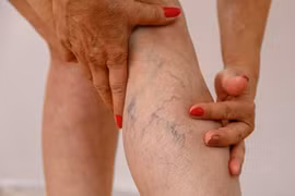 Các biện pháp tự nhiên giúp giảm giãn tĩnh mạch