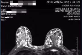 Người phụ nữ bị biến chứng ngực nặng sau làm đẹp tại cơ sở 'chui'