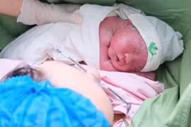 Giữ thai thành công sau khi bị hội chứng truyền máu song thai