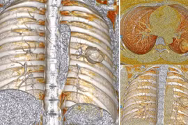 Ung thư phổi tế bào nuôi - căn bệnh nguy hiểm, hiếm gặp