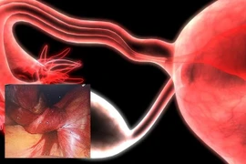 Phẫu thuật cấp cứu thành công cho bé gái 14 tuổi mắc u nang buồng trứng xoắn