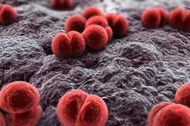 Một bệnh nhân nam 24 tuổi ở xã Thường Tín mắc bệnh não mô cầu