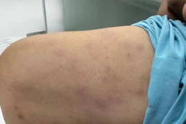 Người đàn ông được chẩn đoán bệnh tự miễn nguy hiểm liên quan đến thuốc