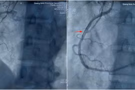 Cứu sống bệnh nhân nhồi máu cơ tim sau mổ nội soi tại Quảng Ninh