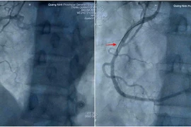 Cứu sống bệnh nhân nhồi máu cơ tim sau mổ nội soi tại Quảng Ninh