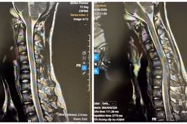 MRI tư thế trung gian và MRI tư thế gập cổ