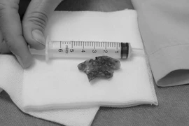 Bệnh nhân nuốt phải hàm răng giả, được cấp cứu nội soi gắp dị vật thành công