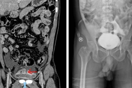 Người đàn ông 46 tuổi vỡ bàng quang sau khi uống nhiều bia, bị ngã