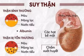 Sai lầm phổ biến khi điều trị suy thận khiến bệnh nặng hơn