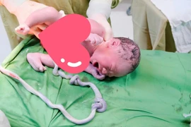 Bé trai 3,3 kg bị dây rốn thắt hai nút hiếm gặp chào đời an toàn 
