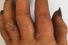 Nguy cơ dị ứng từ thuốc nhuộm tóc, lời khuyên từ bác sĩ da liễu