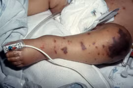 Bệnh não mô cầu tăng cao, Bộ Y tế khuyến cáo phòng ngừa gấp rút