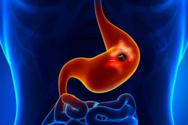 Phẫu thuật cấp cứu bé 13 tuổi vì loét dạ dày do thói quen xấu