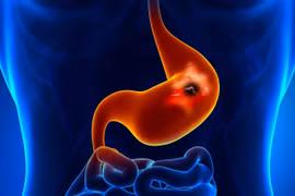 Phẫu thuật cấp cứu bé 13 tuổi vì loét dạ dày do thói quen xấu