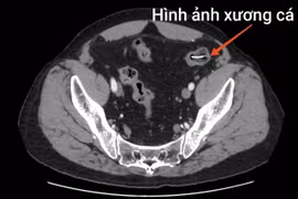 Người đàn ông bị xương cá dài 4 cm đâm thủng ruột non nguy hiểm