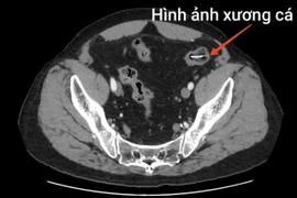 Người đàn ông bị xương cá dài 4 cm đâm thủng ruột non nguy hiểm