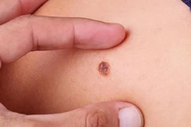 Dấu hiệu nhận biết ung thư da