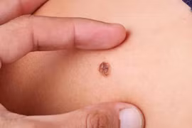 Dấu hiệu nhận biết ung thư da