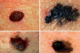 Ung thư tế bào hắc tố trên da có nguy hiểm không?