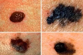 Ung thư tế bào hắc tố trên da có nguy hiểm không?
