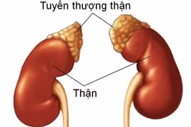 Suy tuyến thượng thận là tình trạng rối loạn trao đổi chất ở thận. Ảnh minh họa/Nguồn Internet