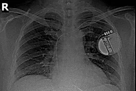 Cấy máy khử rung tim, cứu sống bệnh nhân mắc rối loạn nhịp tim nguy hiểm