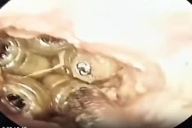 5 con giòi sống trong tai người phụ nữ ở Khánh Hòa