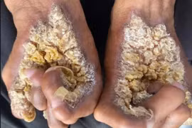 Người đàn ông ở Ninh Bình mắc hội chứng 'người cây' nguy hiểm ra sao?