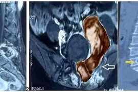 Người phụ nữ 48 tuổi tái phát khối u cột sống hiếm gặp