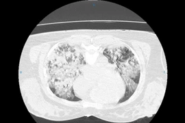 15 ngày giành sự sống cho nữ bệnh nhân 43 tuổi bị đuối nước mặn nguy kịch