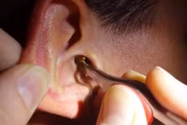 Con rết chui vào tai khiến bé trai 11 tuổi đau dữ dội
