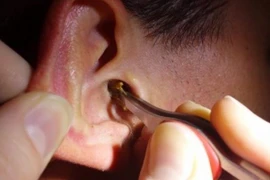 Con rết chui vào tai khiến bé trai 11 tuổi đau dữ dội