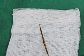 Một bệnh nhân nam bị thủng ruột non do dị vật tăm tre