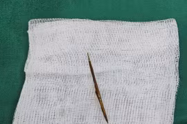 Một bệnh nhân nam bị thủng ruột non do dị vật tăm tre