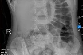 Bé gái 5 tuổi bị táo bón kéo dài gây tiểu dầm hàng đêm