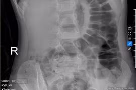 Bé gái 5 tuổi bị táo bón kéo dài gây tiểu dầm hàng đêm